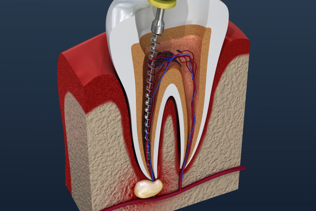 benefits of root canal treatment